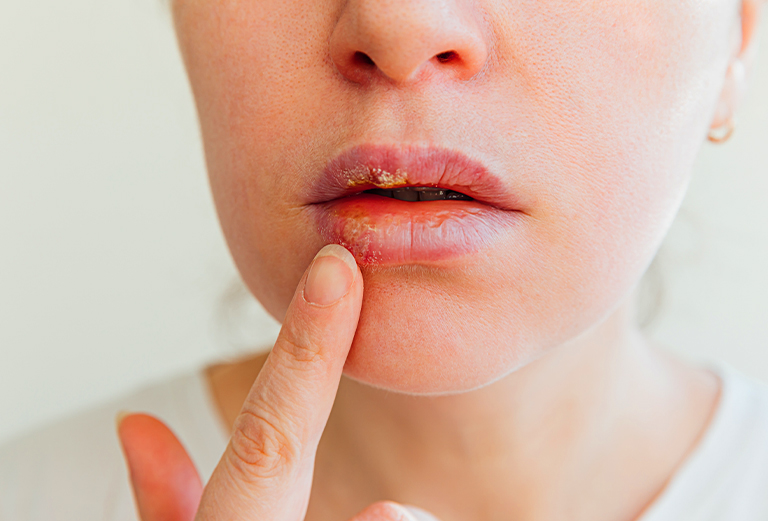 Cold Sore Treatment Near Me