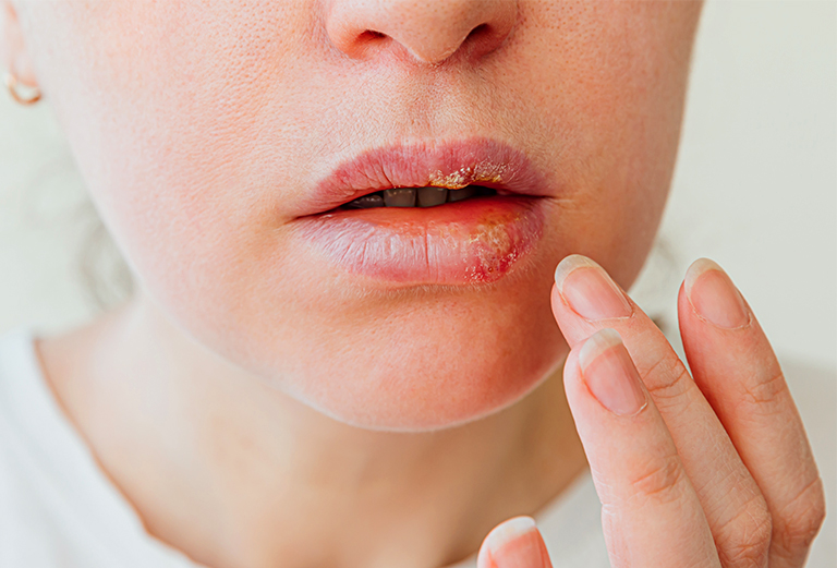 cold sores treatment