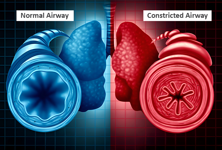 bronchitis medicine online