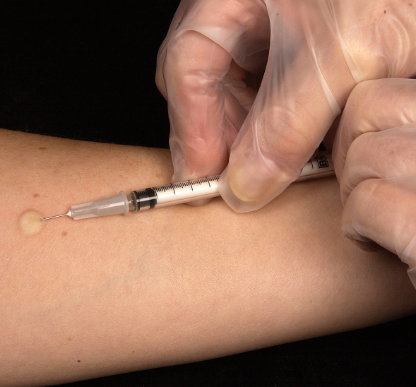 PPD Skin Test