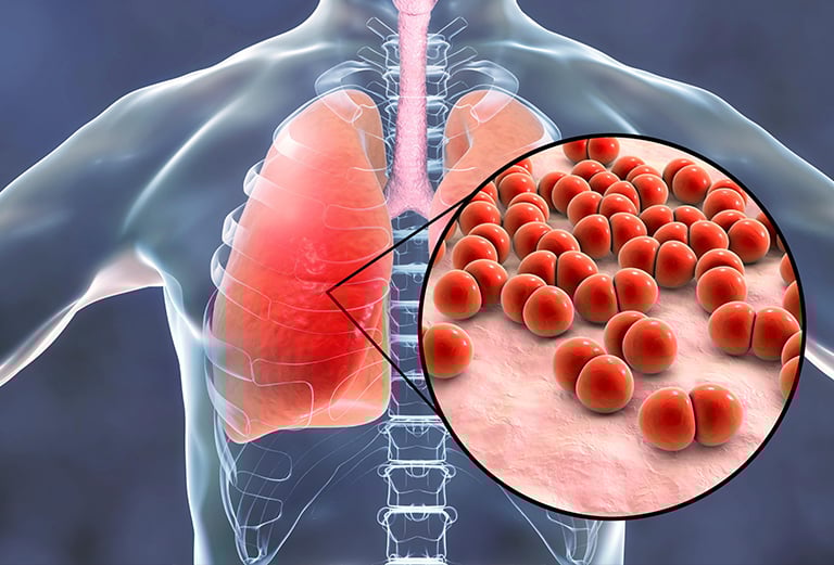 pneumonia specialist ca