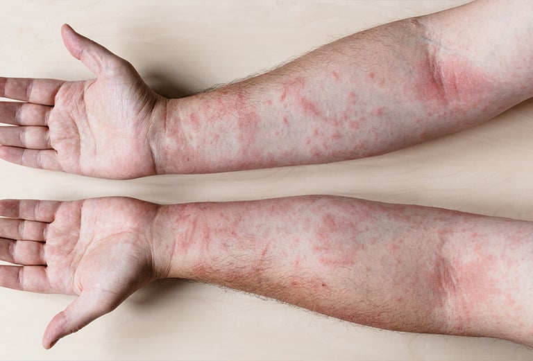 poison oak rash treatment