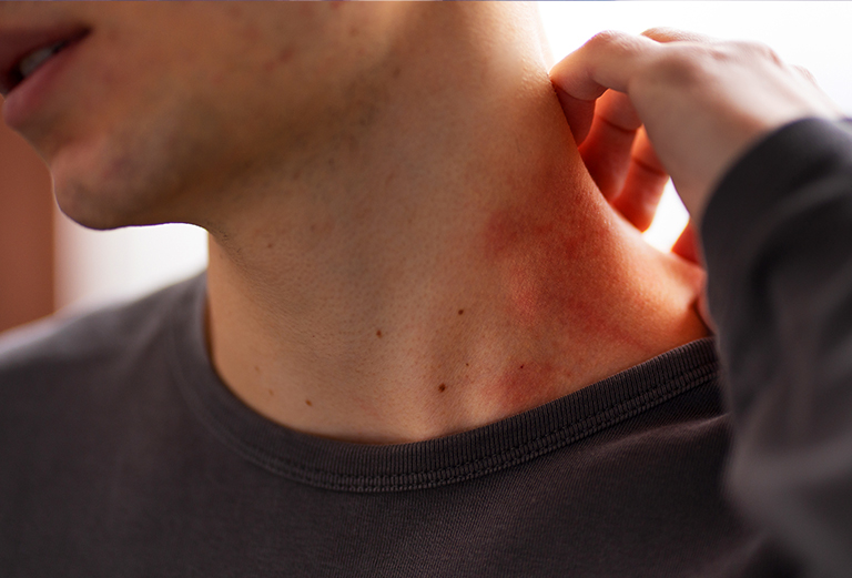 skin rash treatment