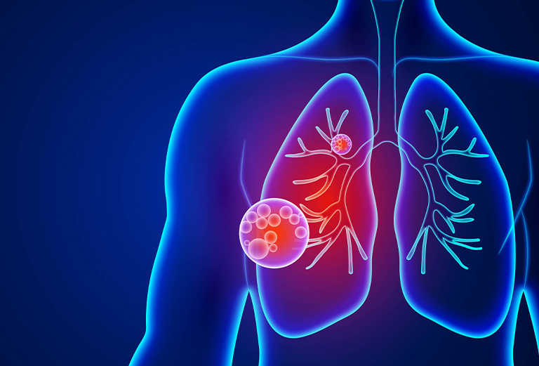 pneumonia specialist near me