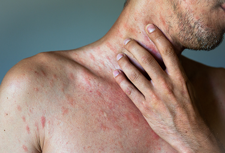 Skin Rashes Treatment
