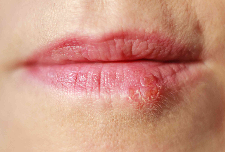 cold sores treatment