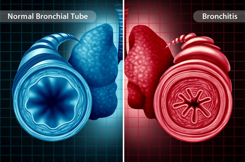 Bronchitis treatment
