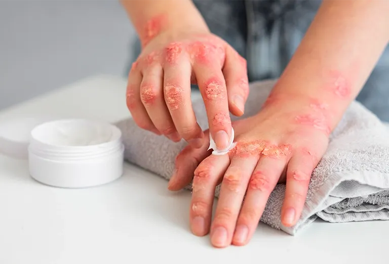 Skin Rashes Treatment